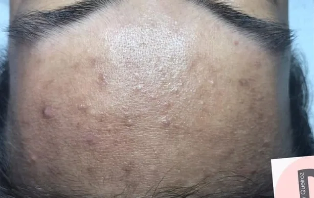 Antes — Resultado de Acne — caso 01
