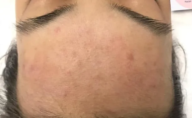Depois — Resultado de Acne — caso 01