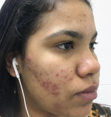 Antes — Resultado de Acne — caso 02