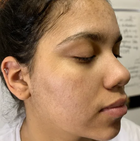 Depois — Resultado de Acne — caso 02