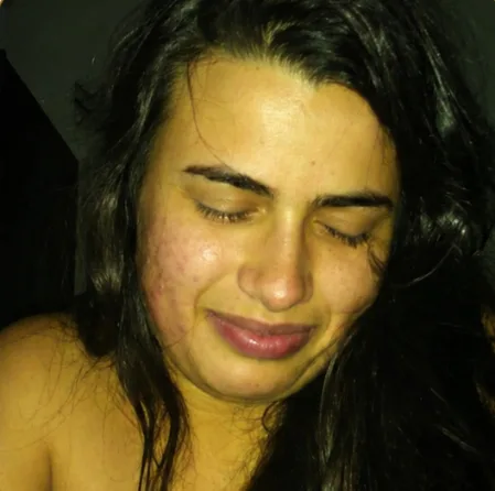 Antes — Resultado de Acne — caso 03
