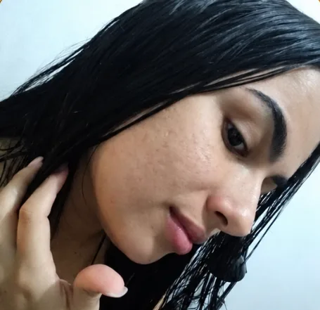 Depois — Resultado de Acne — caso 03