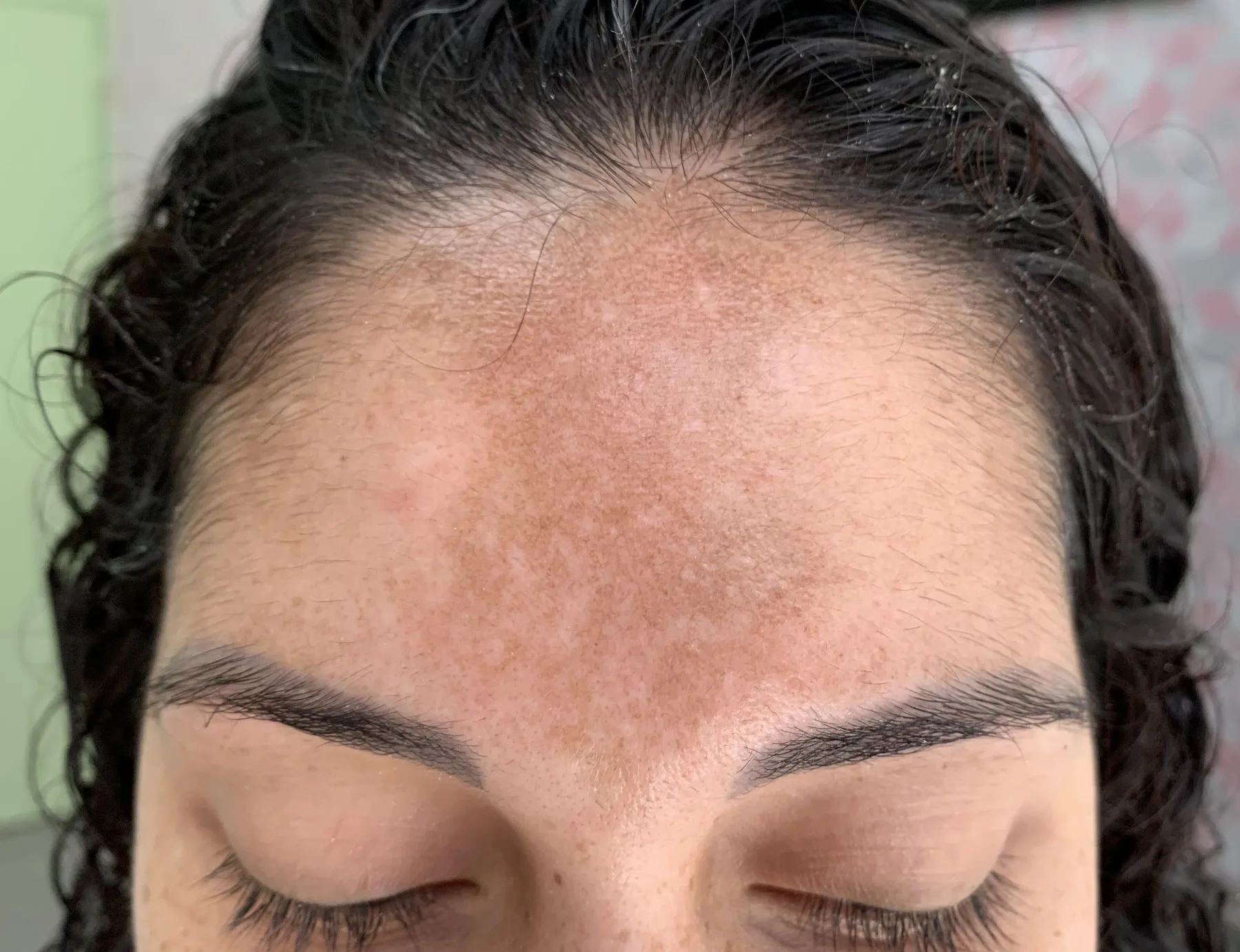 Antes — Resultado de Melasma — caso 01