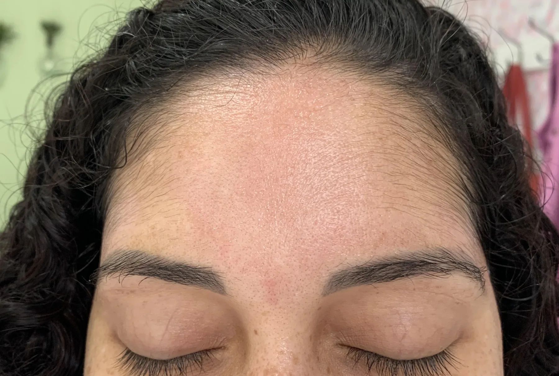 Depois — Resultado de Melasma — caso 01
