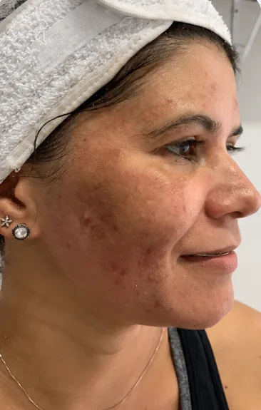 Antes — Resultado de Melasma — caso 02