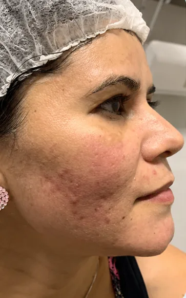 Depois — Resultado de Melasma — caso 02