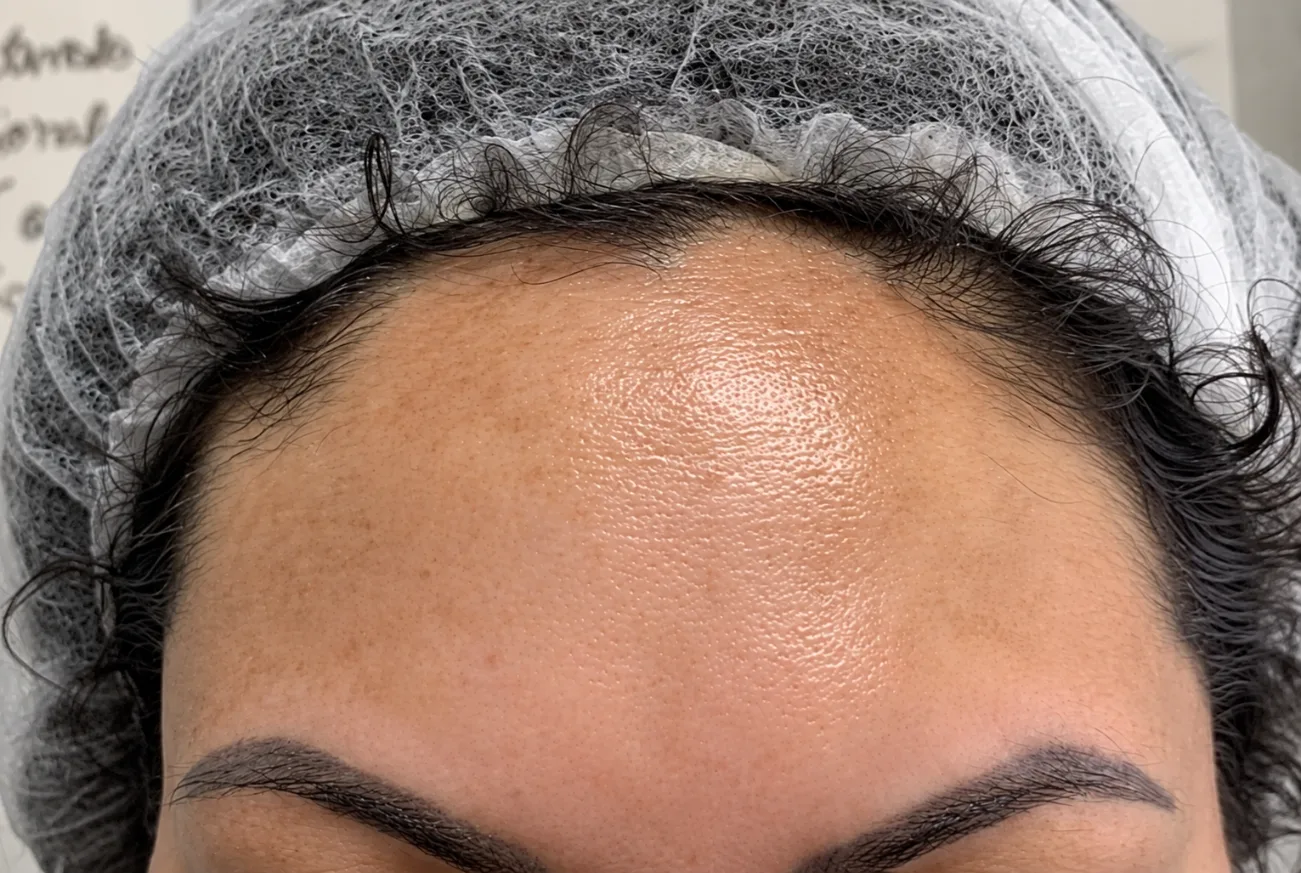 Depois — Resultado de Melasma — caso 03