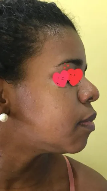 Depois — Resultado de Remoções — caso 07