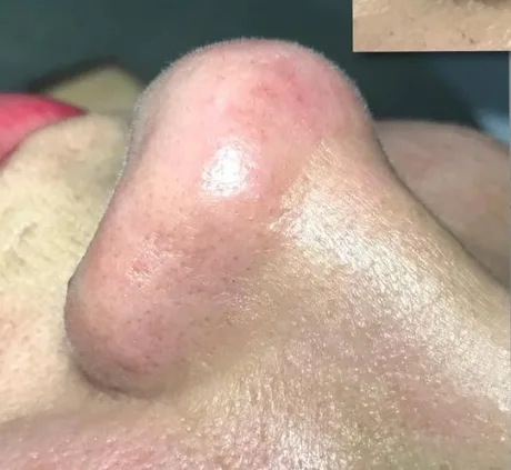 Depois — Resultado de Limpeza de Pele nanotecnologica — caso 04