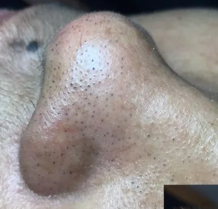Antes — Resultado de Limpeza de Pele nanotecnologica — caso 06