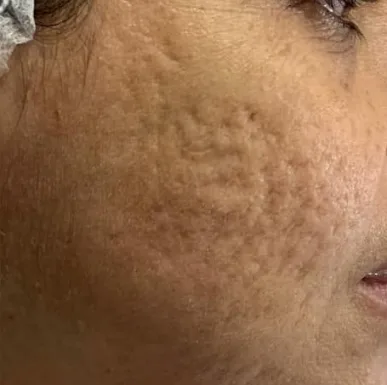 Antes — Resultado de Cicatrizes de Acne — caso 01