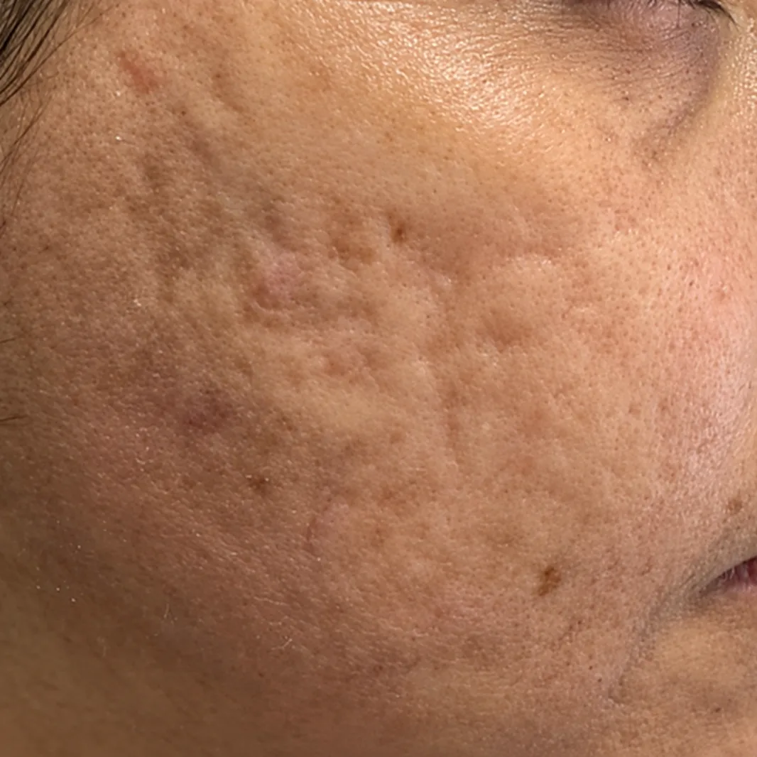 Depois — Resultado de Cicatrizes de Acne — caso 01