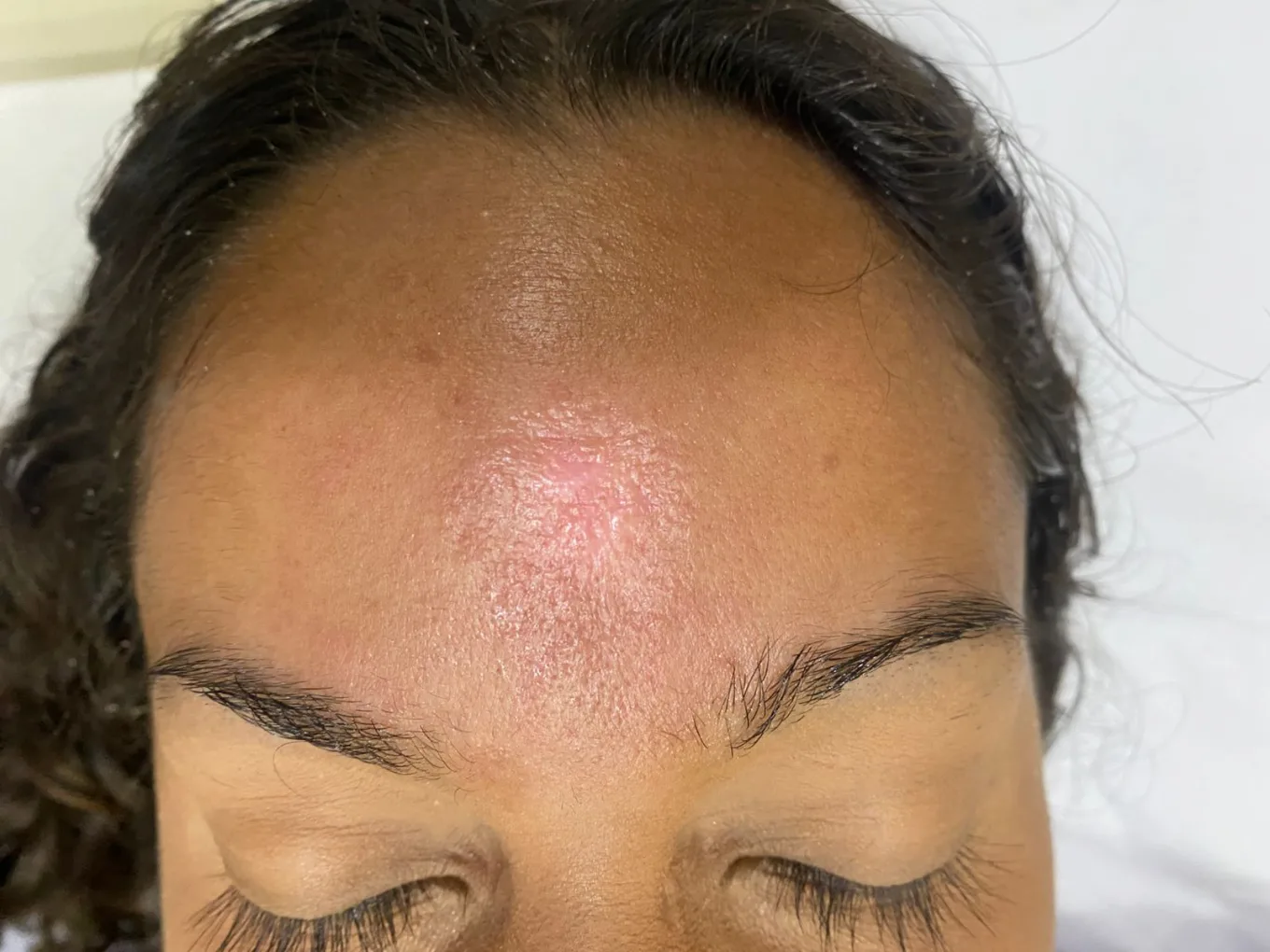Depois — Resultado de Tratamento de cicatrizes por esporotricose — caso 01