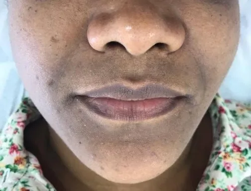Antes — Clareamento facial
