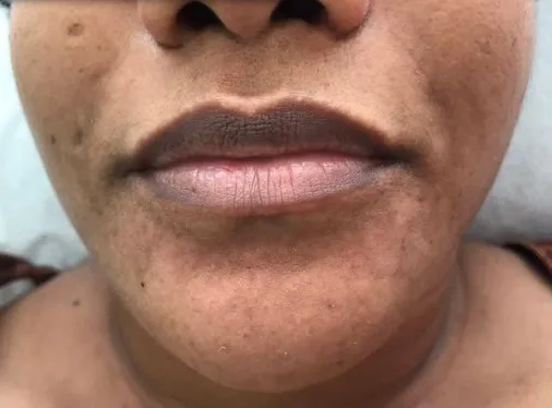 Depois — Clareamento facial
