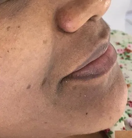 Clareamento facial — foto 1