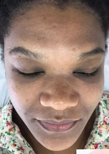 Clareamento facial — foto 2