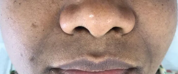 Clareamento facial — foto 3