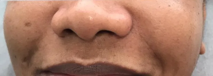Clareamento facial — foto 4