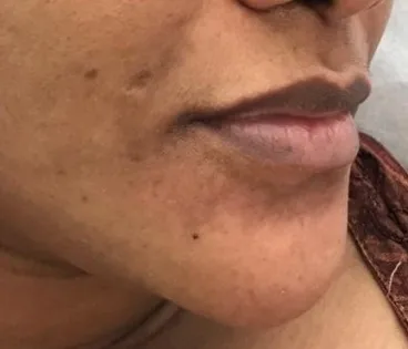 Clareamento facial — foto 5