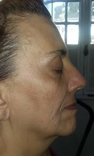 Antes — Resultado com mais de 2 meses de tratamento