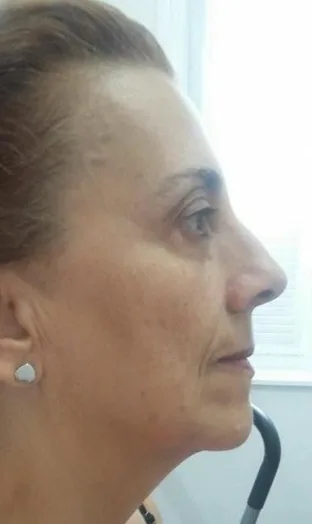 Depois — Resultado com mais de 2 meses de tratamento