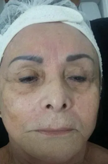 Antes — Tratamento de rejuvenescimento facial