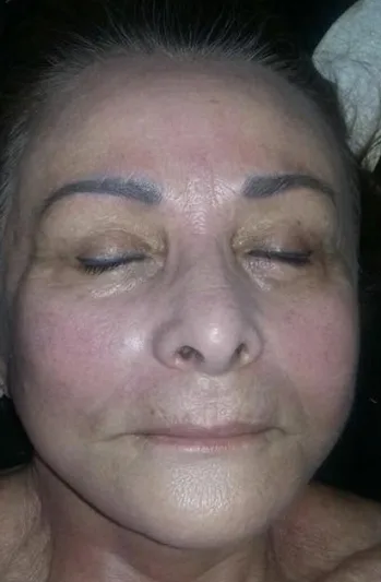 Depois — Tratamento de rejuvenescimento facial